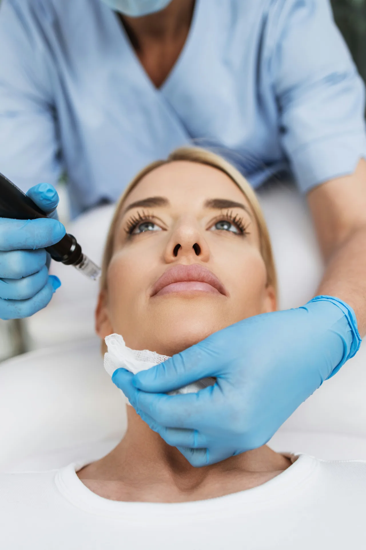 Radiofrequency microneedling treatment on the lower face