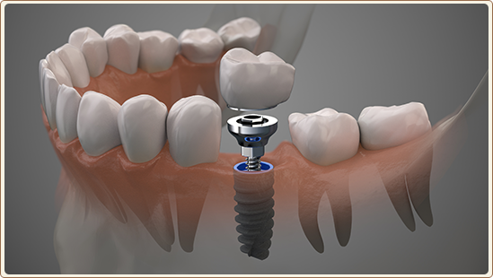 Dental Implants