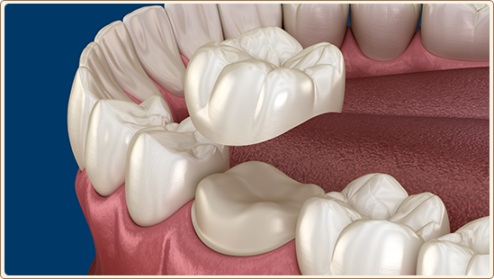 Dental Crowns