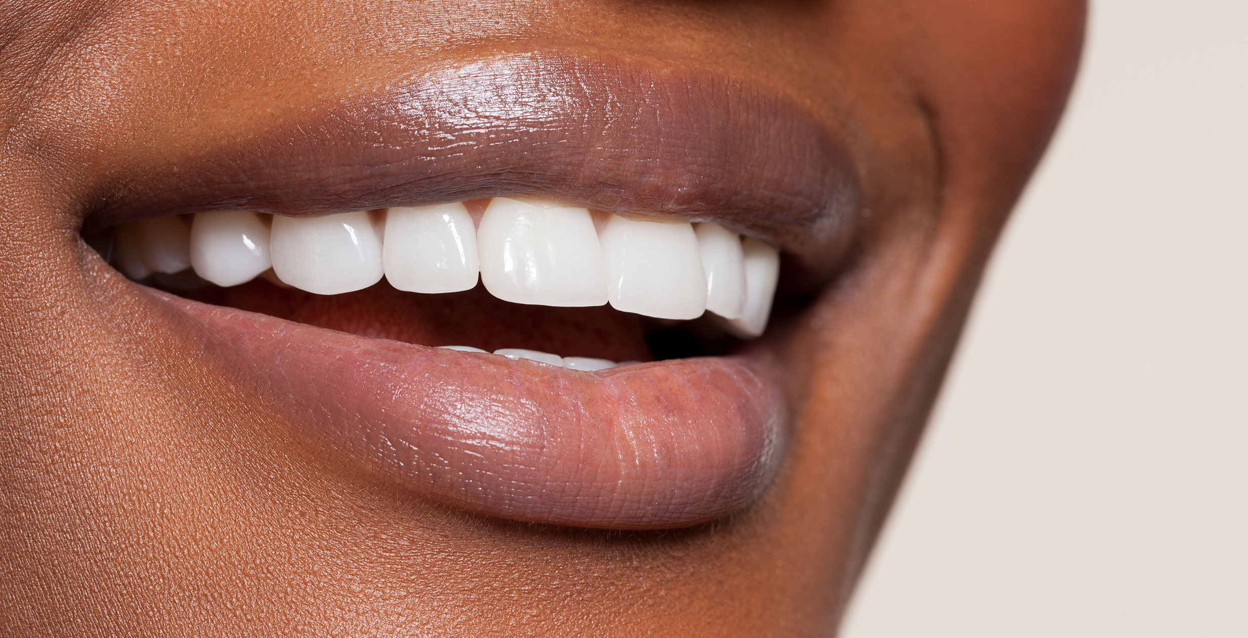 Woman with teeth whitening