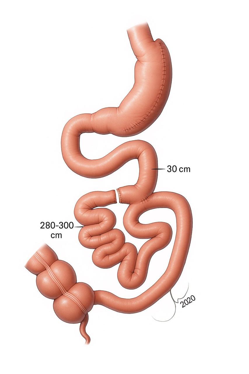 Manga con bypass yeyunal