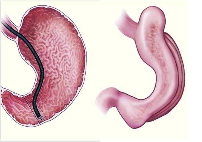 Gastroplastía endoscópica