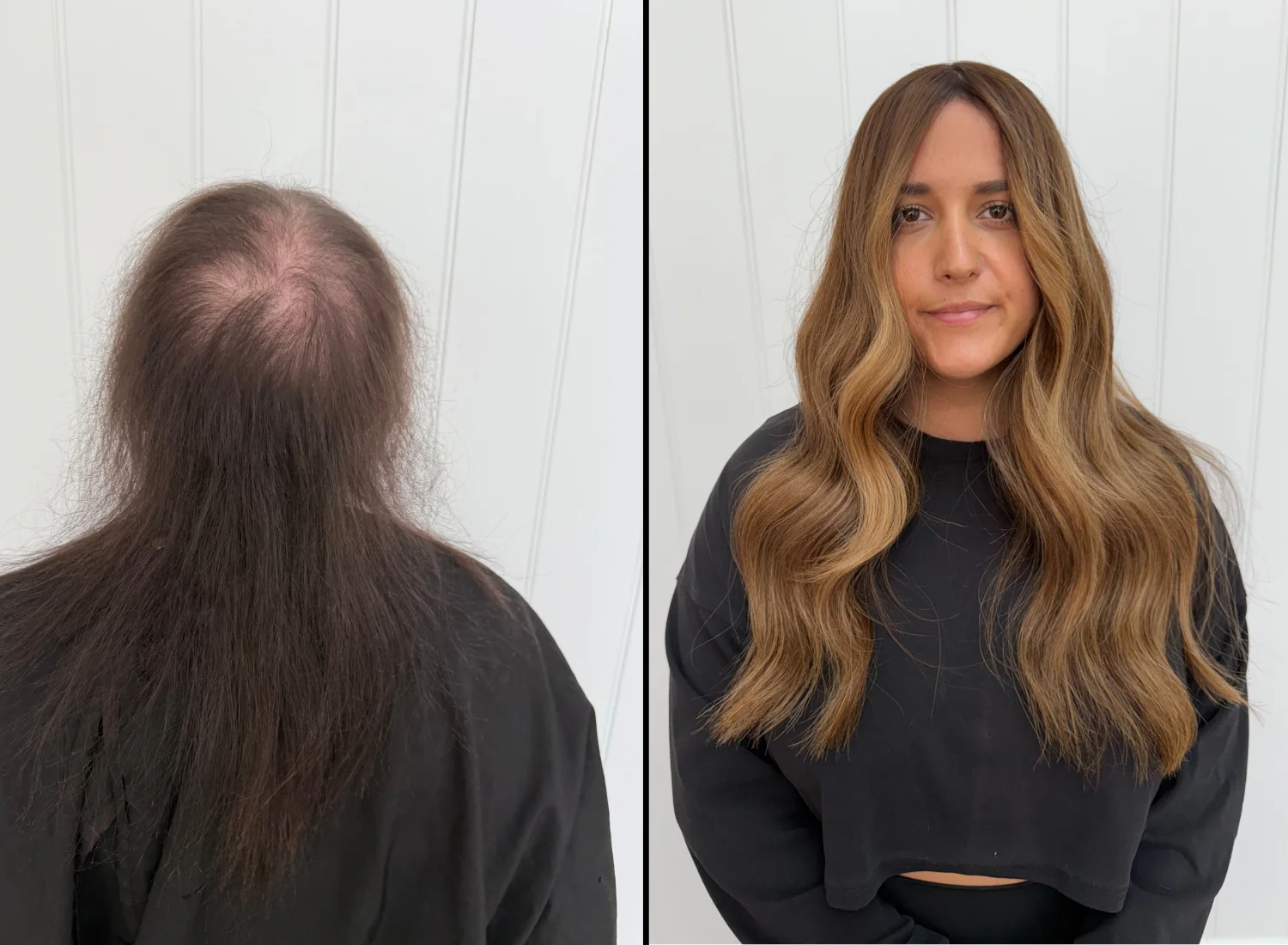 Skalp360 advanced non-surgical hair system transformation for women at Pamela Pilakis Hair Melbourne