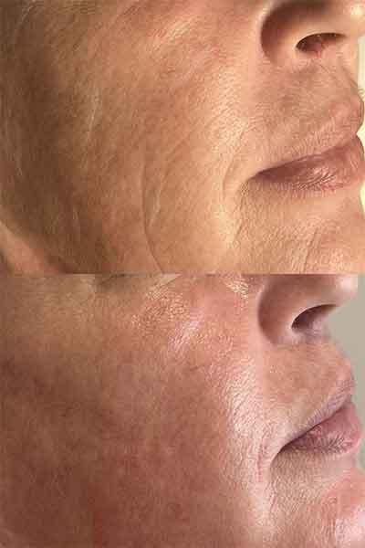 two faces showing before and after treatments for profhilo