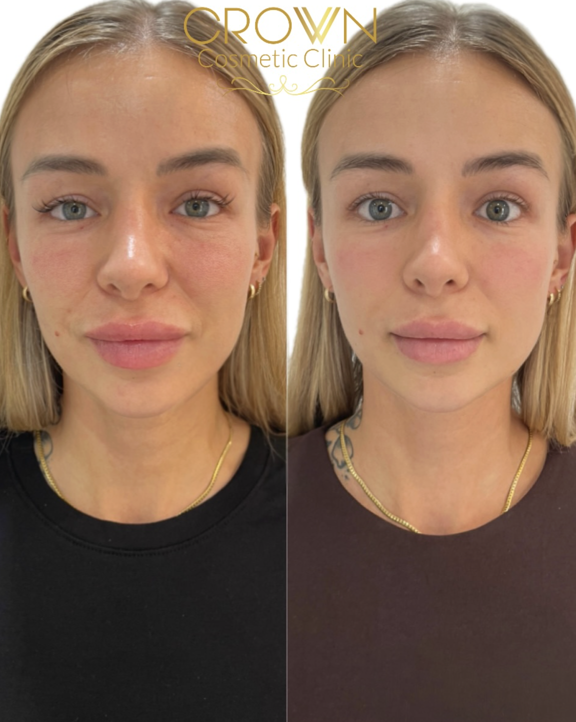 Crown client skin transformation