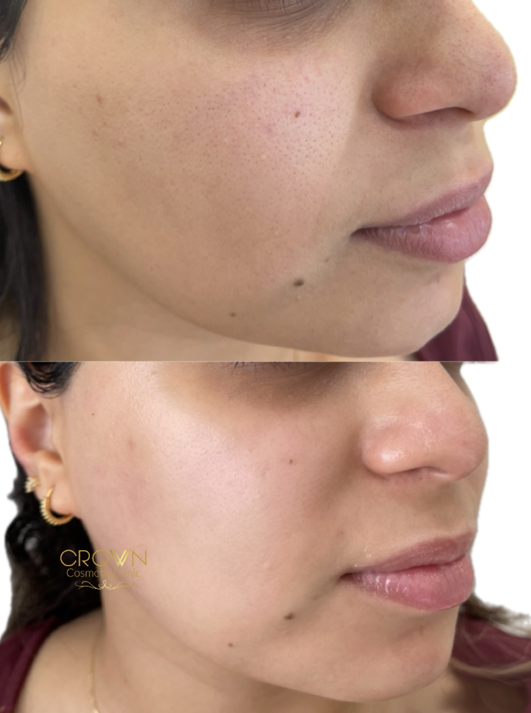 Crown client skin transformation