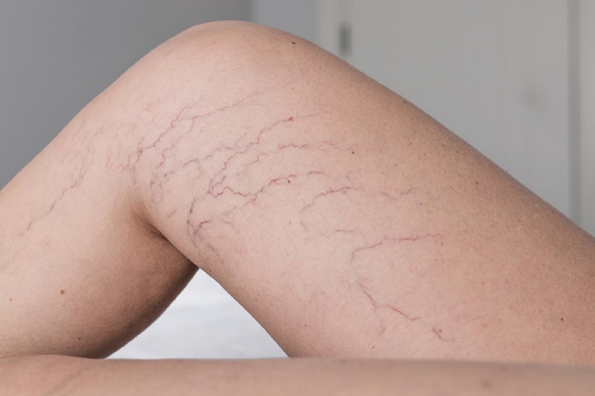 Spider Veins Spider Veins