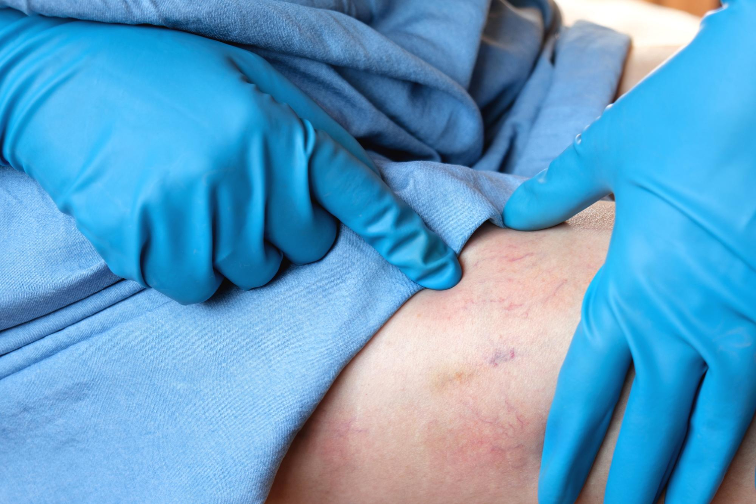 Varicose Veins Varicose Veins
