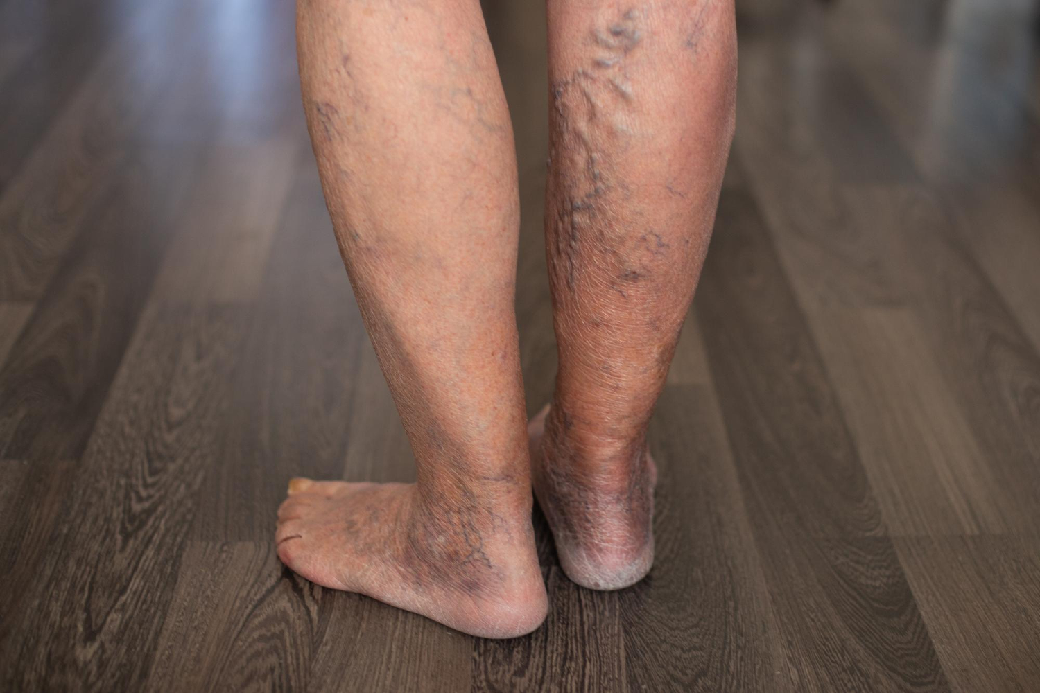 Spider Veins Spider Veins