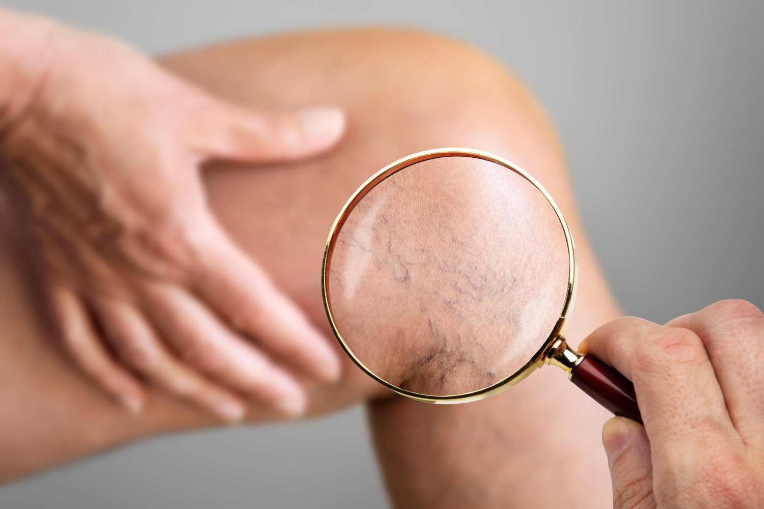 Venous Insufficiency Venous Insufficiency