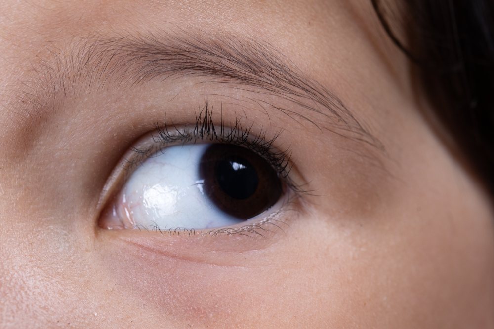 nystagmus