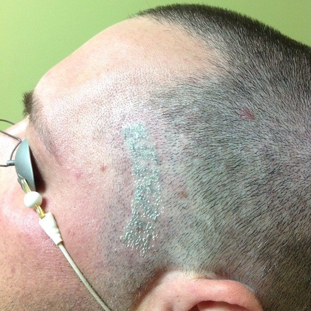 Facial tattoo before and after PicoSure laser removal — after