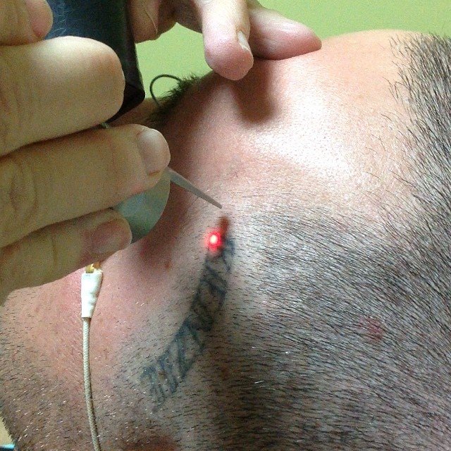 Facial tattoo before and after PicoSure laser removal — before