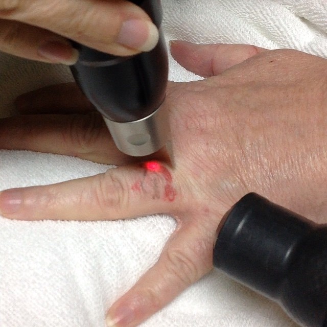 PicoSure laser tattoo removal treatment on a hand at H8MyTat in Redlands
