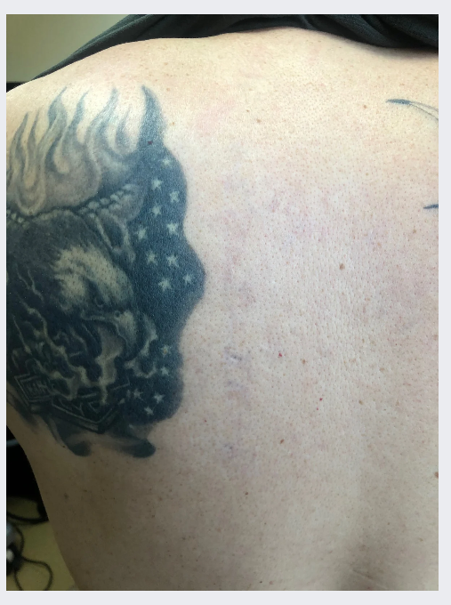 Back tattoo before and after PicoSure laser removal — after