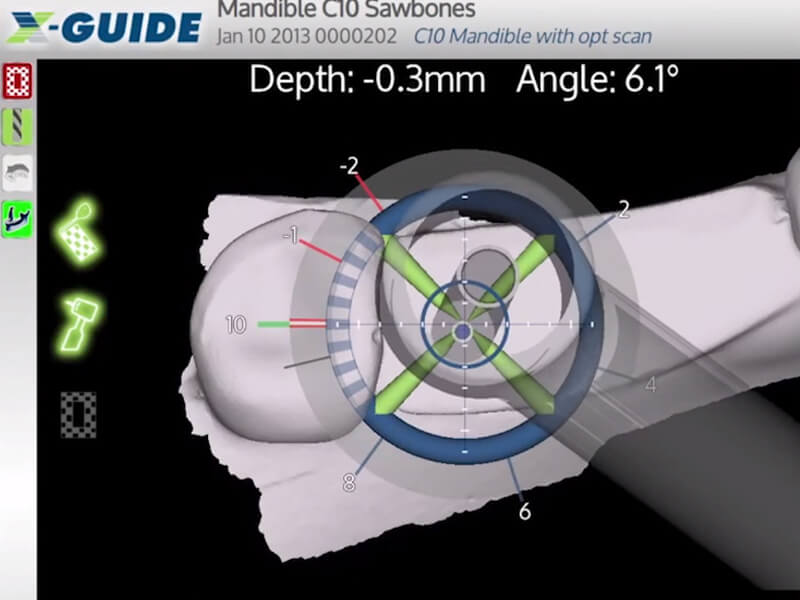 X-Guide navigation screen tracking implant drill depth and angle in real time