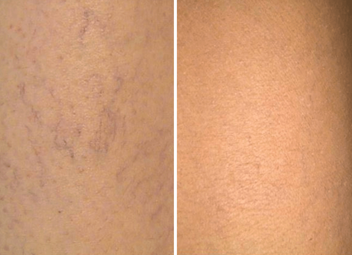 spider vien treatments