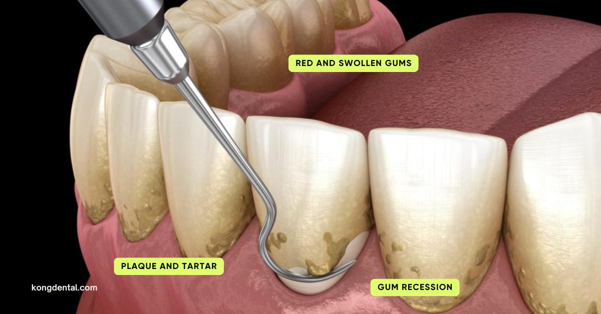 Patient with gum disease receiving a dental examination
