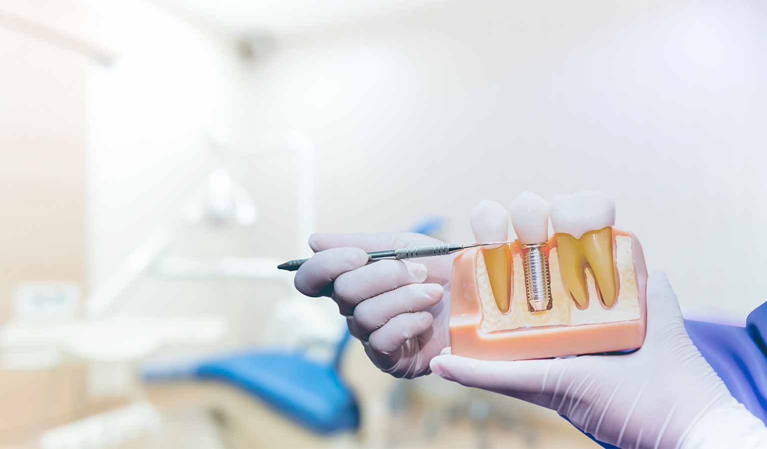 Dental Implant in Singapore Dental Implant in Singapore
