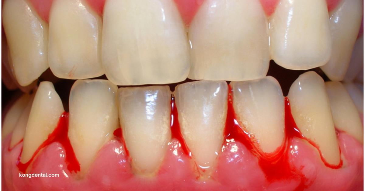 bleeding gum | Kong Dental Surgery bleeding gum | Kong Dental Surgery