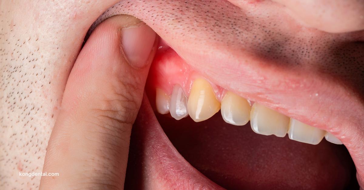 Swollen Gums | Kong Dental Surgery Swollen Gums | Kong Dental Surgery