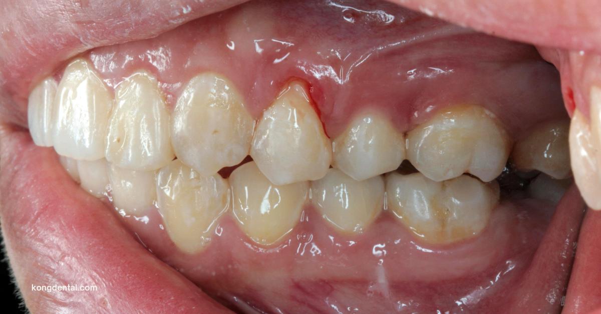 Receding Gums | Kong Dental Surgery Receding Gums | Kong Dental Surgery