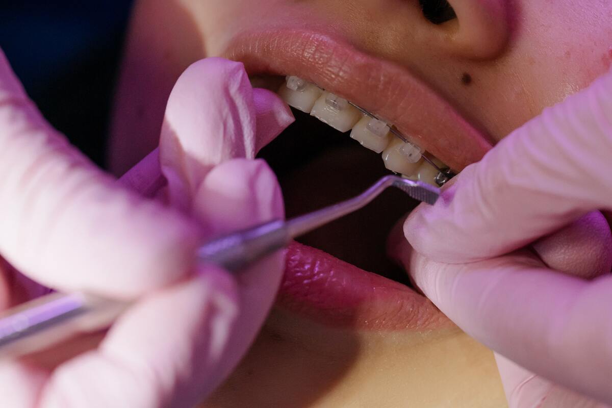 Dental treatment done on an open mouth with gentle dentistry