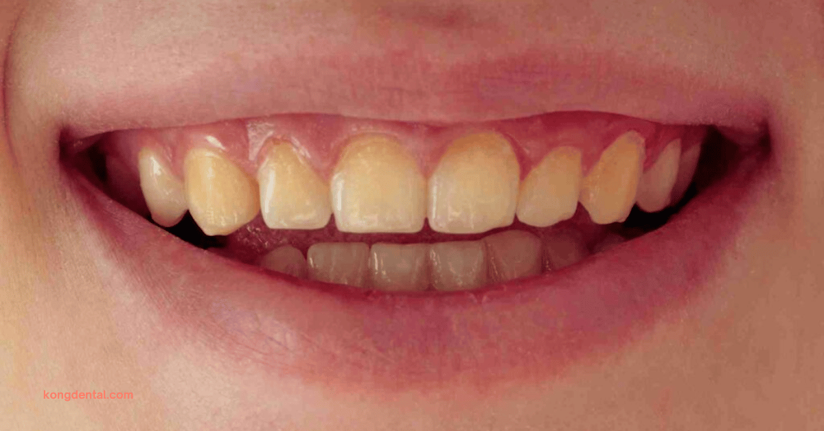 Yellow Tooth Discolouration - Kong Dental Surgery Yellow Tooth Discolouration - Kong Dental Surgery
