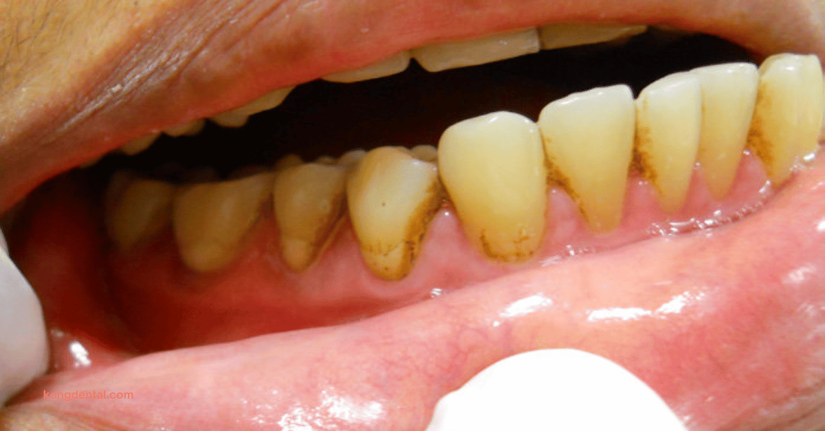 Brown Tooth Discolouration - Kong Dental Surgery Brown Tooth Discolouration - Kong Dental Surgery