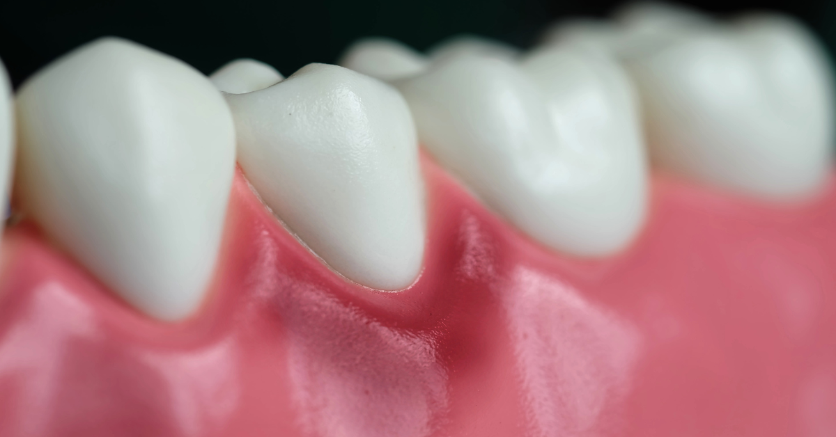 Gum Disease in Singapore: What It Is, Why It Is So Common, and What to Do About It