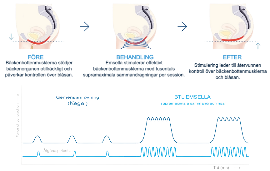 hur fungerar emsella, emsella behandling, emsella forskning, emsella behandling stockholm