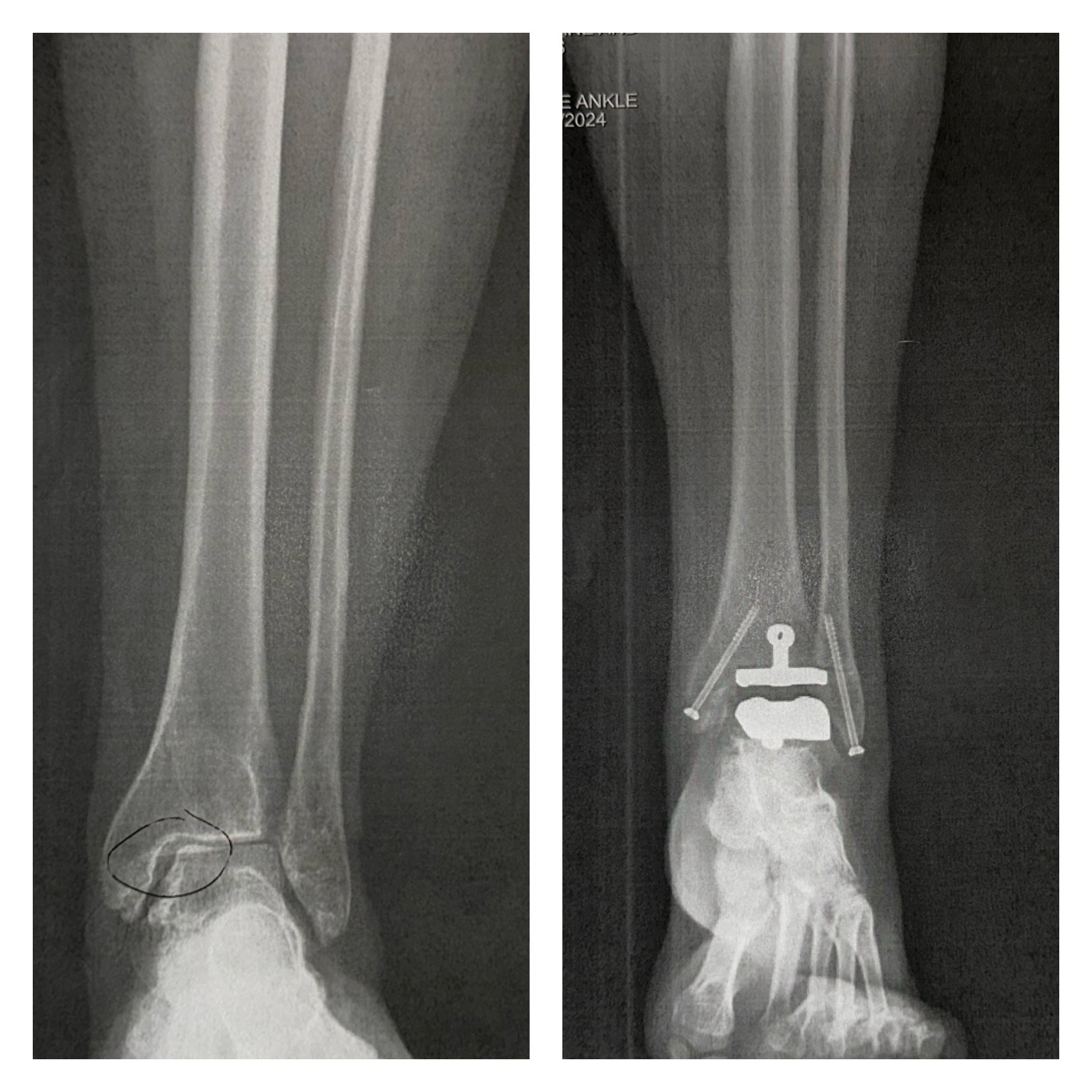 Ankle replacement x-ray