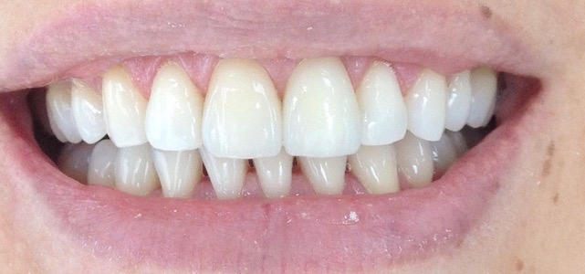 Aplicación de carillas dentales en Cali — Dr. Juan Carlos Martínez