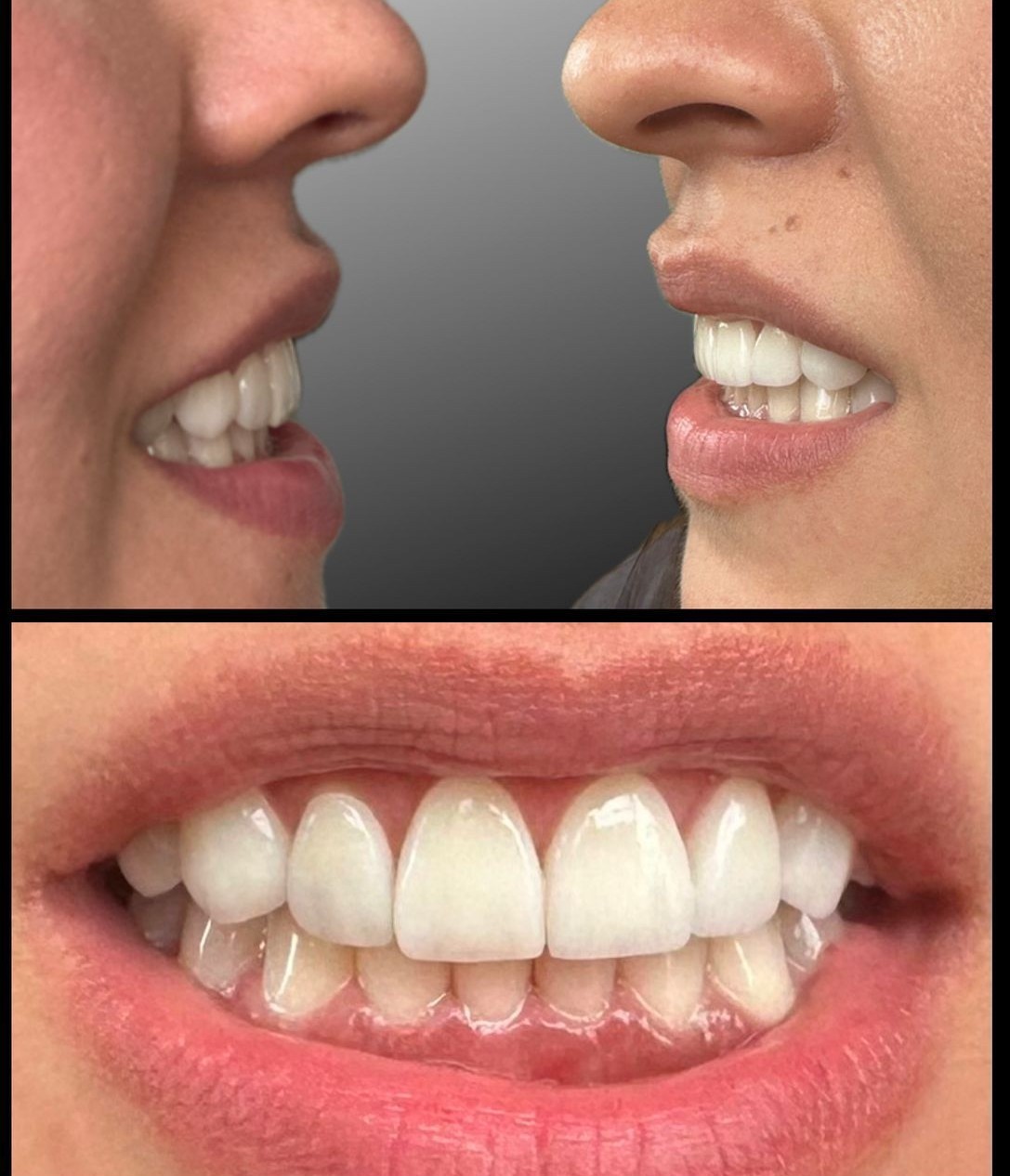 Caso de carillas dentales antes y después en Cali