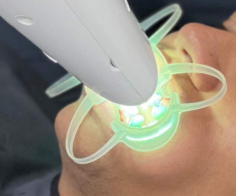 Resultados de blanqueamiento dental en Cali — Dr. Juan Carlos Martínez