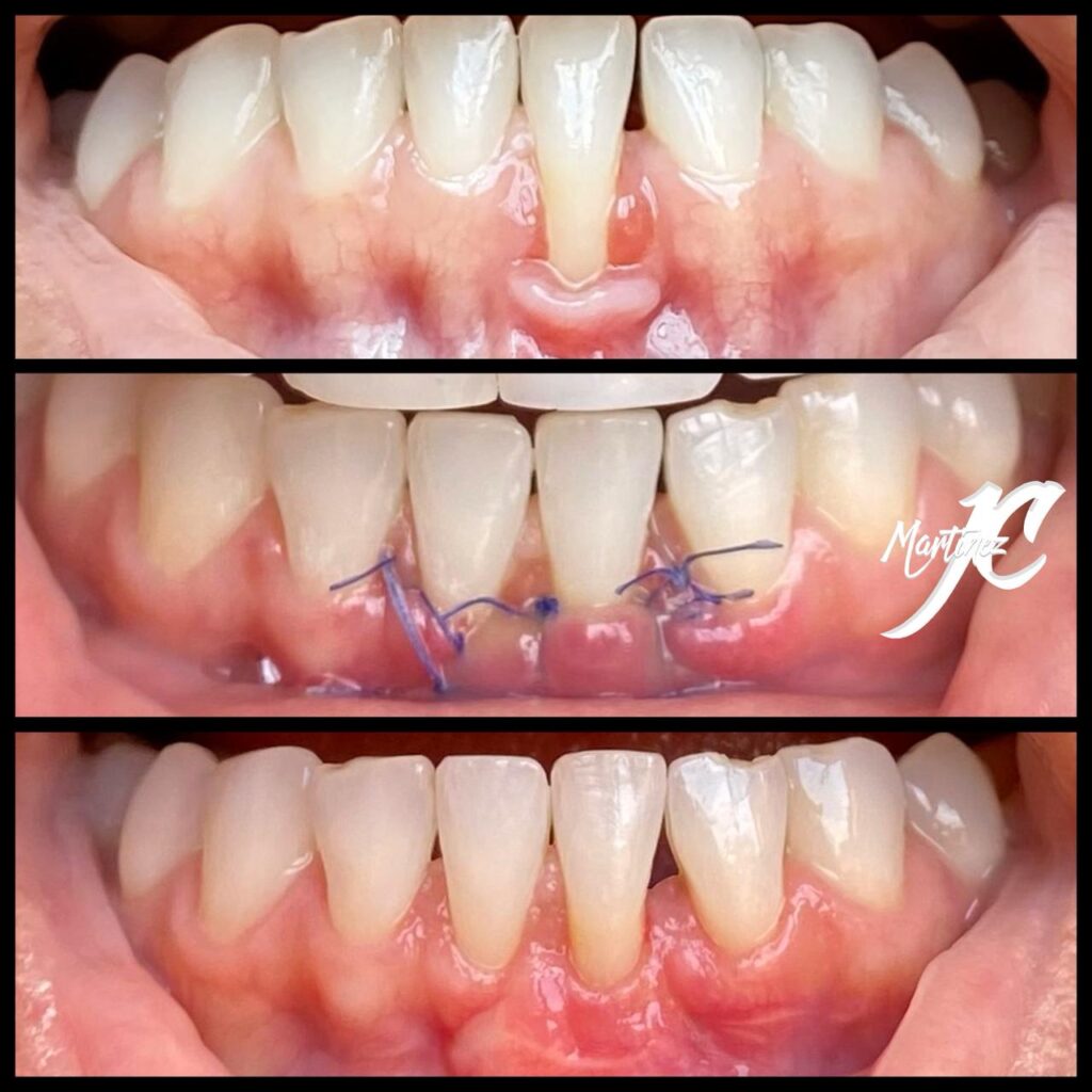 Raspaje y alisado radicular para periodoncia en Cali