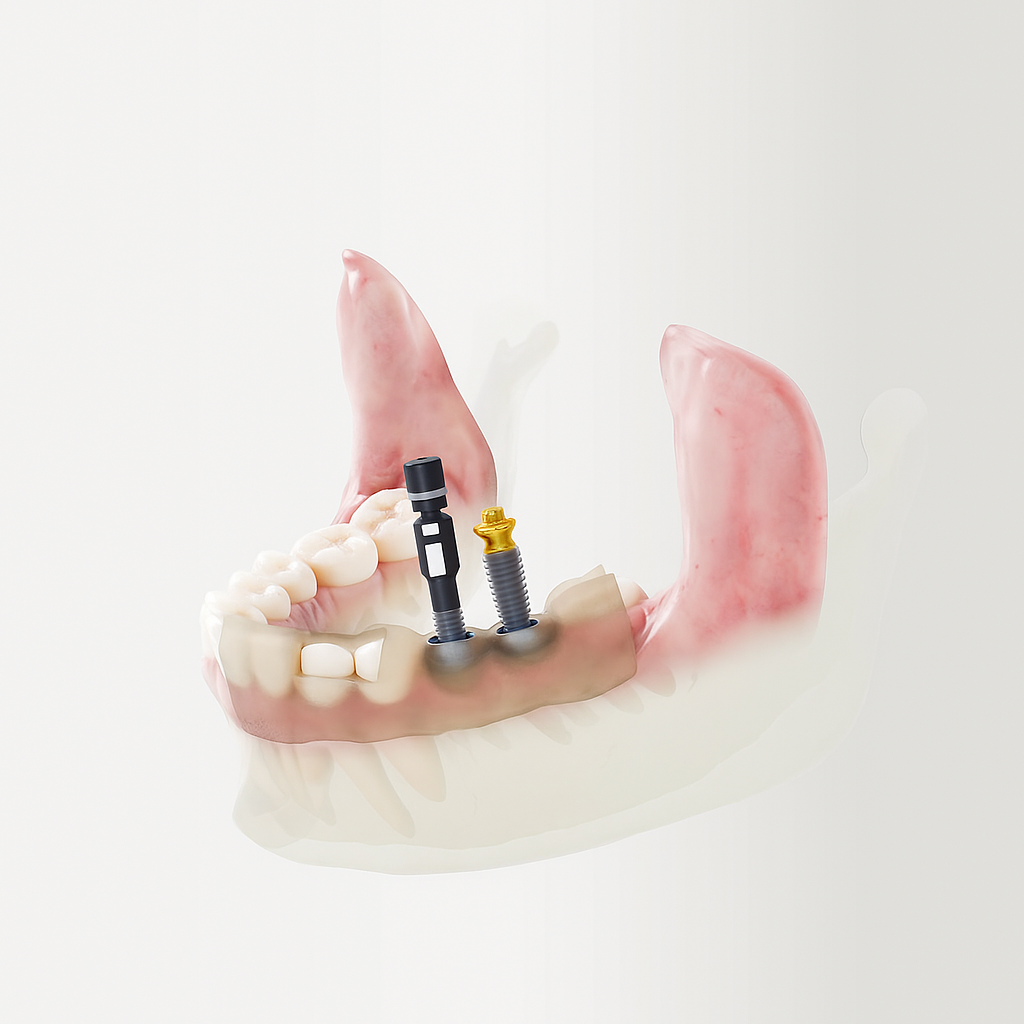Corona sobre implante dental en Cali — resultado natural