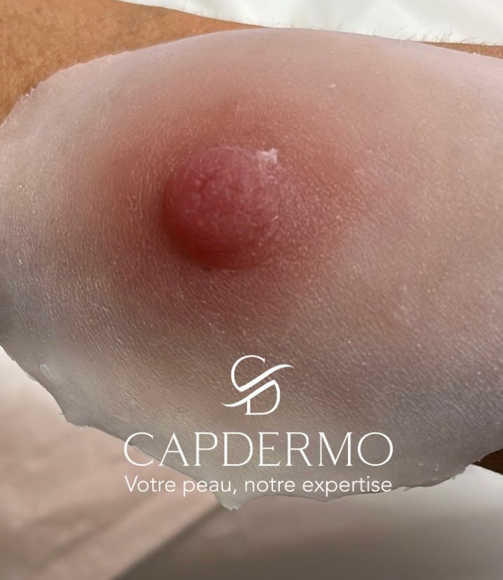 Dermopigmentation réparatrice et prothèses Aréa — CapDermo Le Lamentin