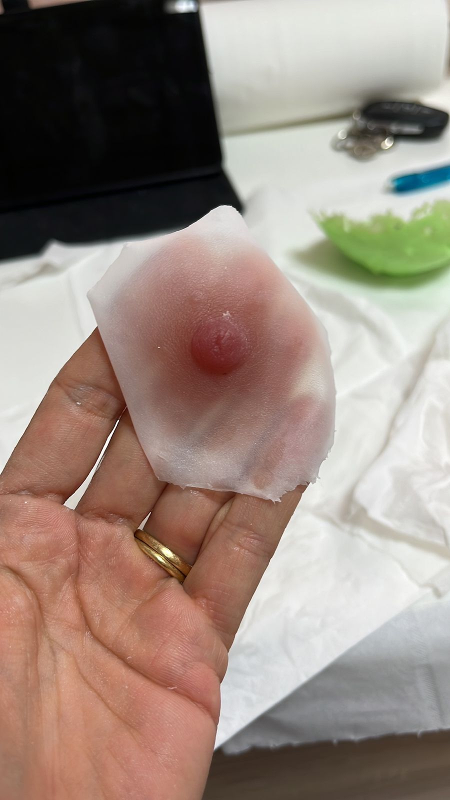 Prothèse Aréa en silicone — alternative non invasive