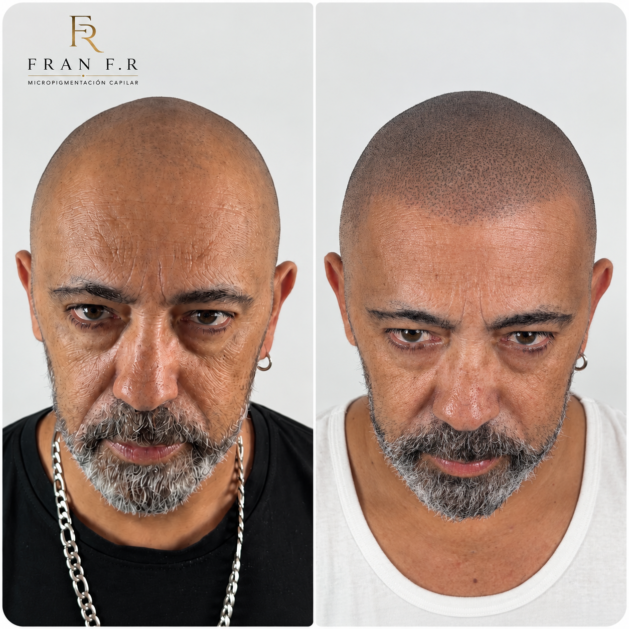 Resultado real de micropigmentación capilar de Fran Ferrer, caso 5