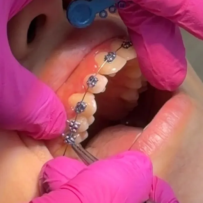 Control de brackets en Salud Integral: ajuste del arco con pinzas