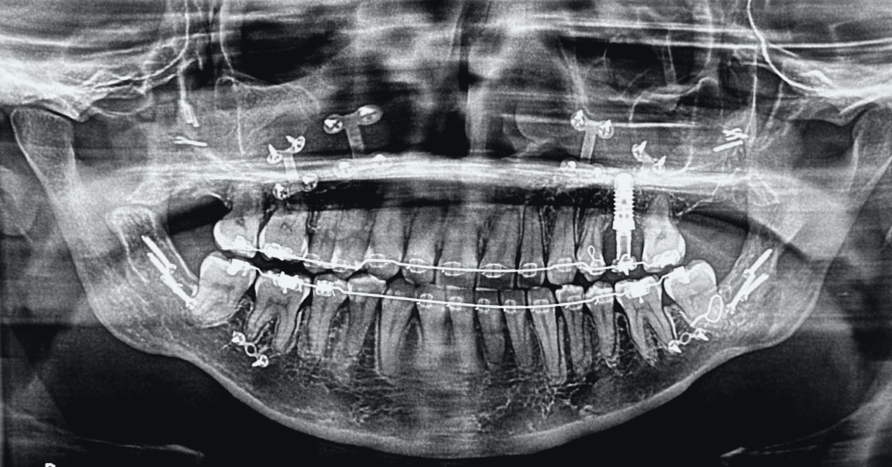 Blake's original panoramic X-ray, unedited apart from cropping