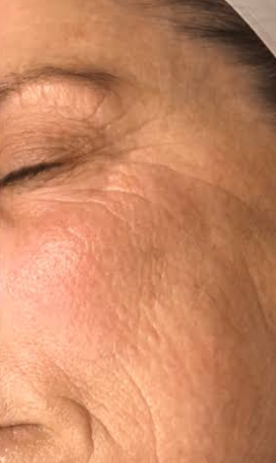 After Nordlys treatment