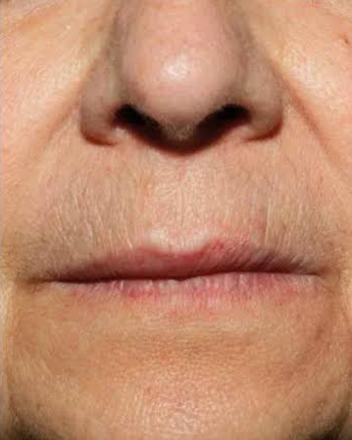 After Nordlys treatment