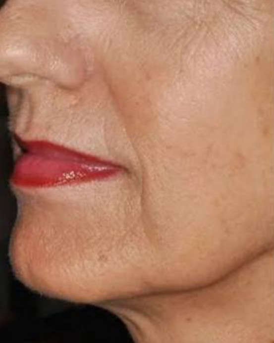Before Nordlys treatment