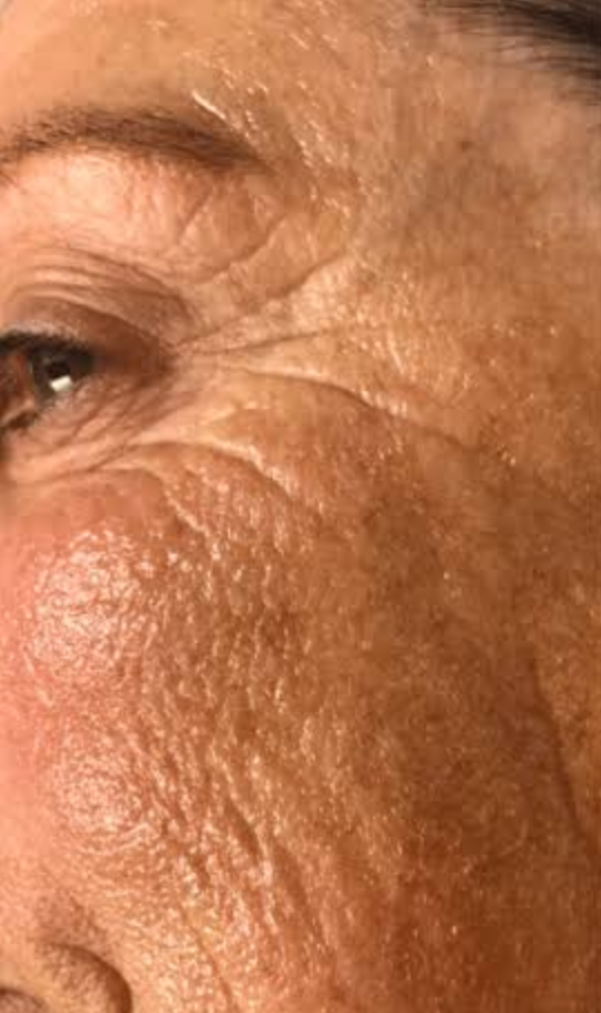 Before Nordlys treatment