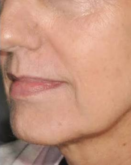 After Nordlys treatment