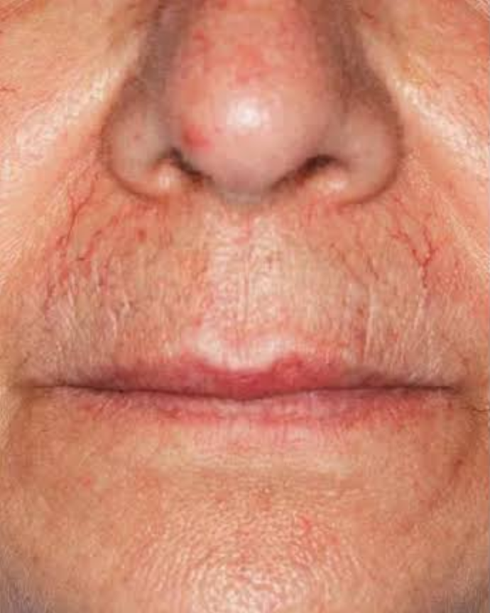 Before Nordlys treatment