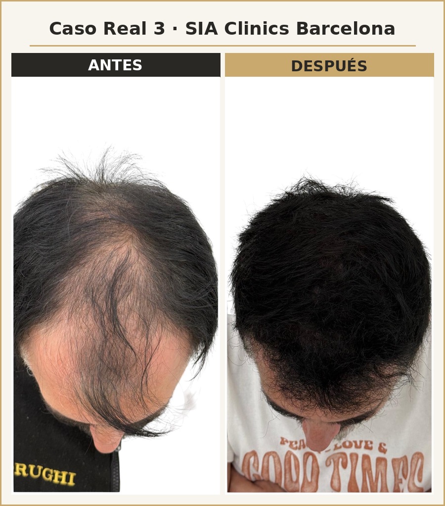 Resultado injerto capilar FUE SIA Clinics Barcelona — caso 3