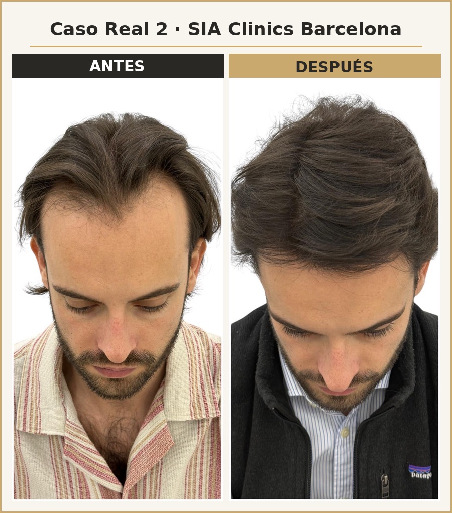 Resultado injerto capilar FUE SIA Clinics Barcelona — caso 2